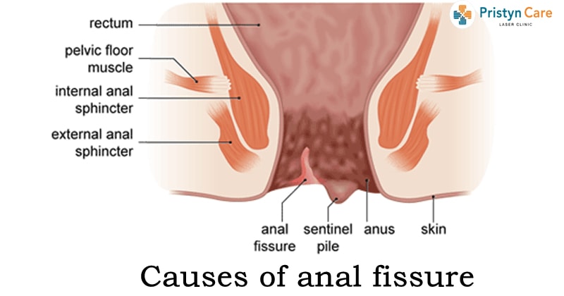 discharge anal fissure