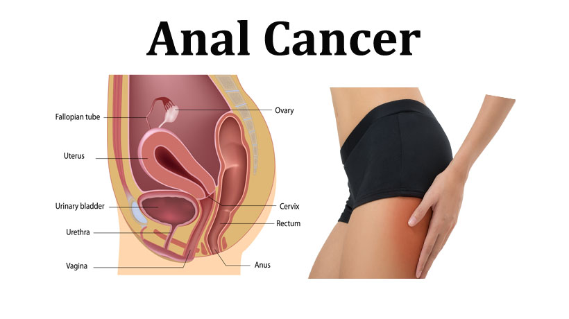 pics anal cancer