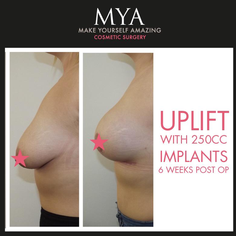 with breast uplift implants