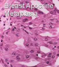 breast apocrine metaplasia