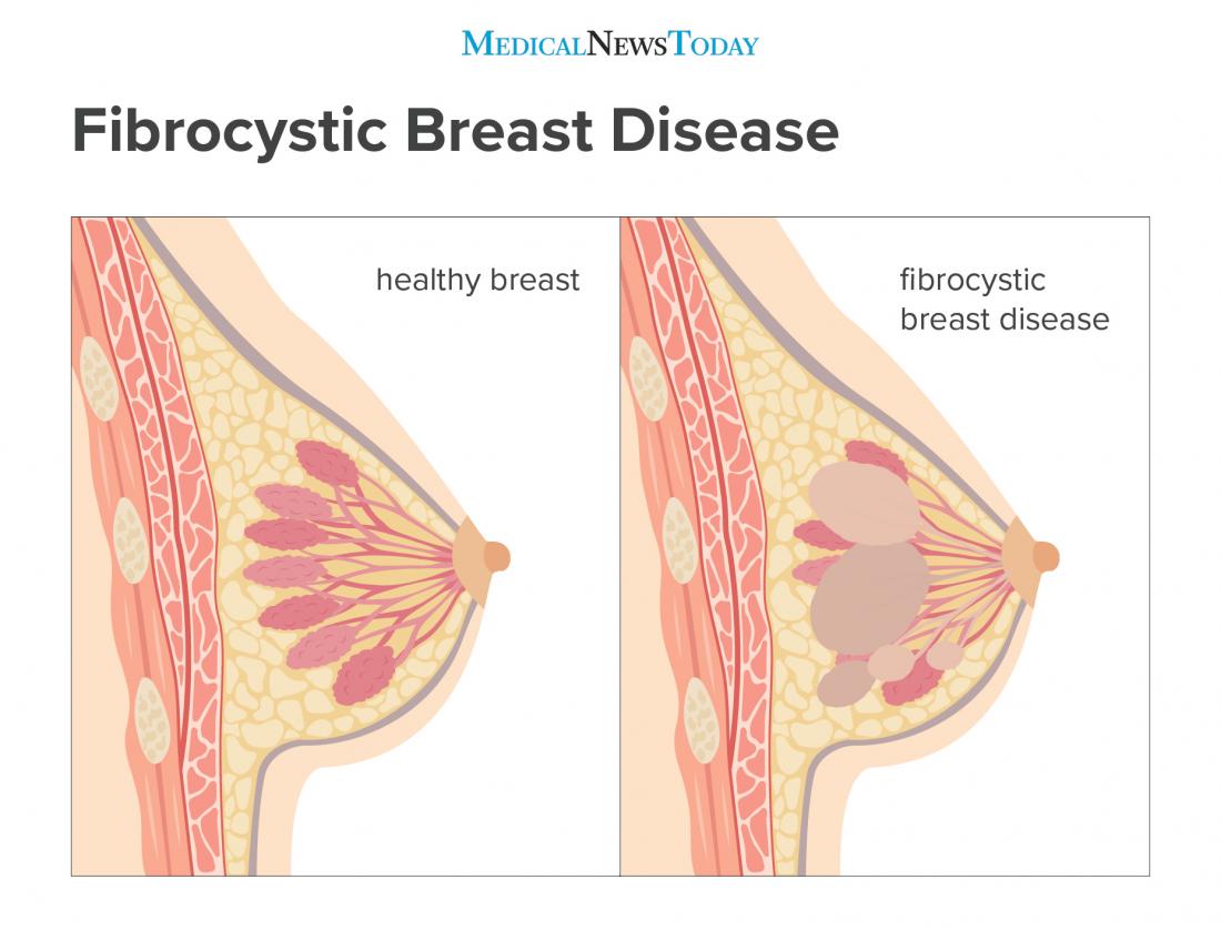 disease of types breast
