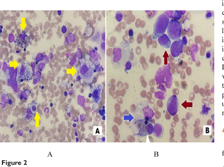 adults in lymphohistiocytosis hemophagocytic
