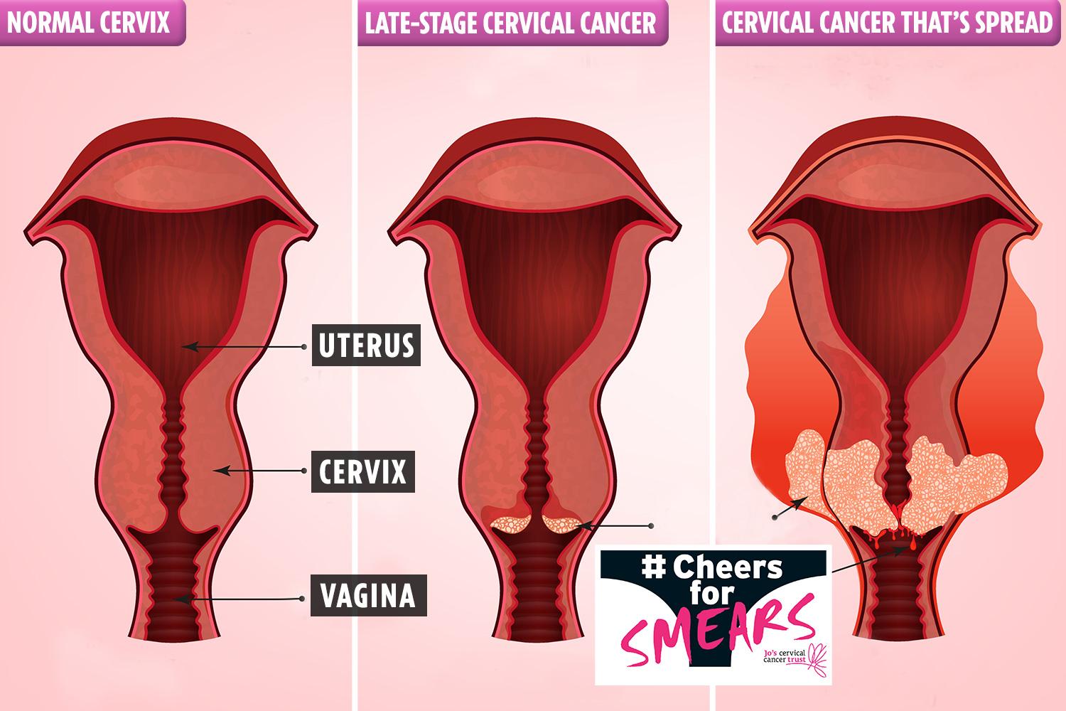 cancer photos vagina