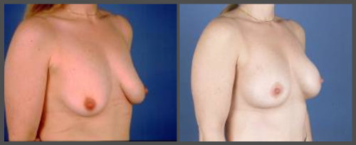 breast implants dallas