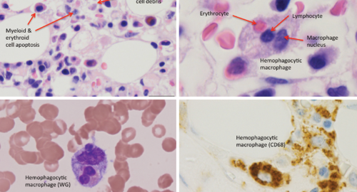 adults in lymphohistiocytosis hemophagocytic