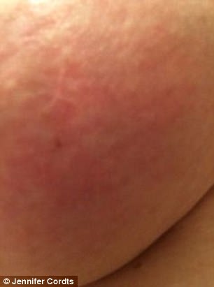 mosquito bite breast cancer