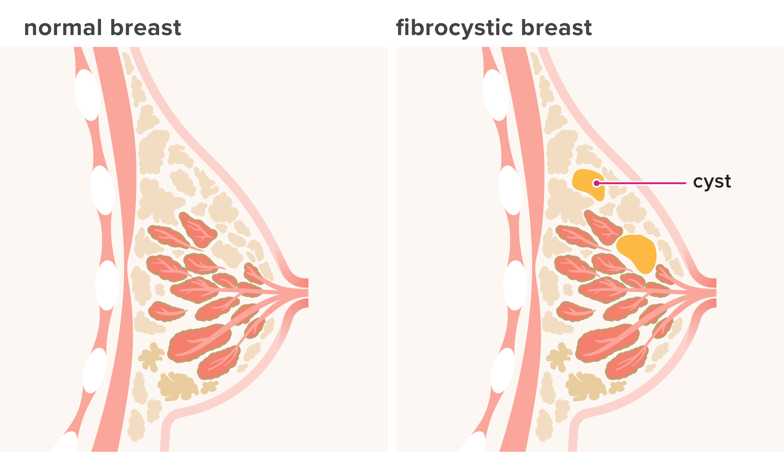 disease of types breast