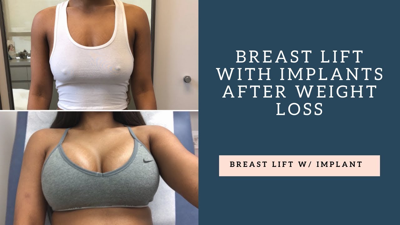 with breast uplift implants