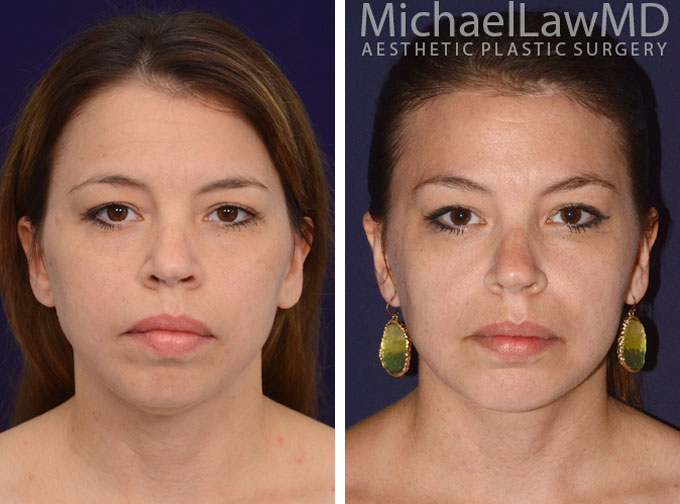 implants pictures facial