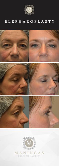 feminization frederick surgery facial