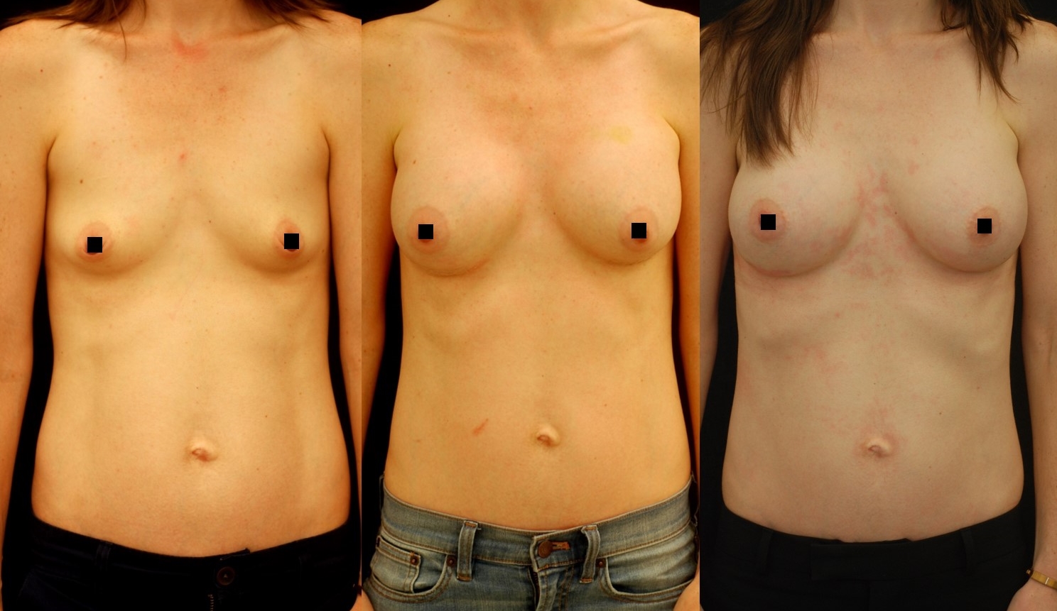 implants manhattan silicone breast